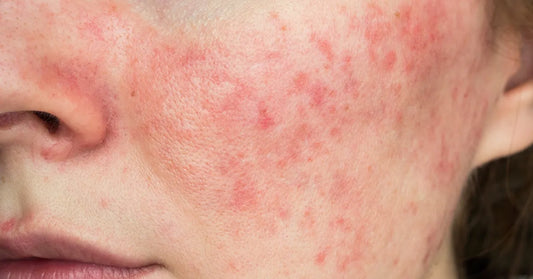 Photo d’une joue présentant une acné rosacée marquée, souvent liée à un problème de foie ou d’inflammation digestive. Illustration dermatologique réaliste.