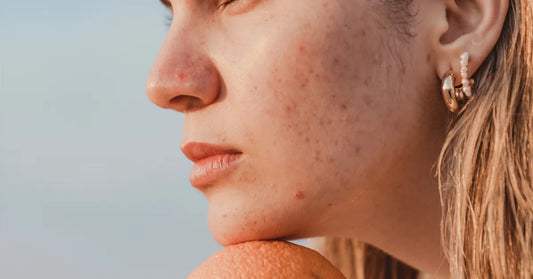Gros plan sur une peau granuleuse du visage montrant un grain de peau irrégulier et des imperfections naturelles