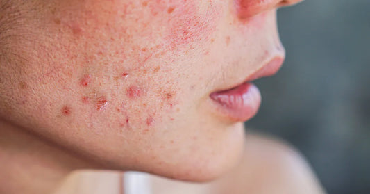 Peau acnéique adulte avec boutons inflammatoires sur la joue - illustration des effets de l'acné hormonale