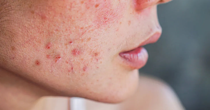 Peau acnéique adulte avec boutons inflammatoires sur la joue - illustration des effets de l'acné hormonale